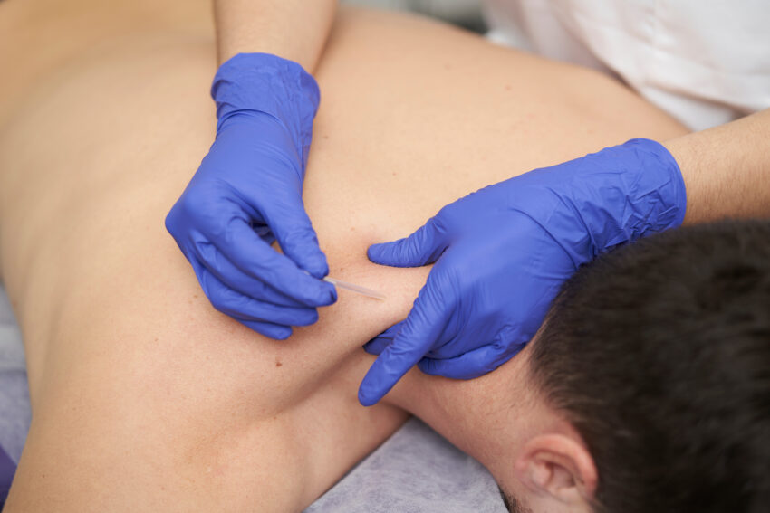 Physiotherapist at Theratouch Physiot using dry needling to treat patient
