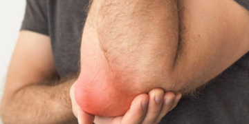 Bursitis: Revitalizing Movement with Physiotherapy