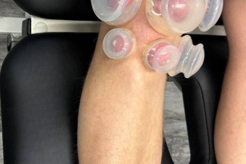 Cupping Therapy in Ottawa
