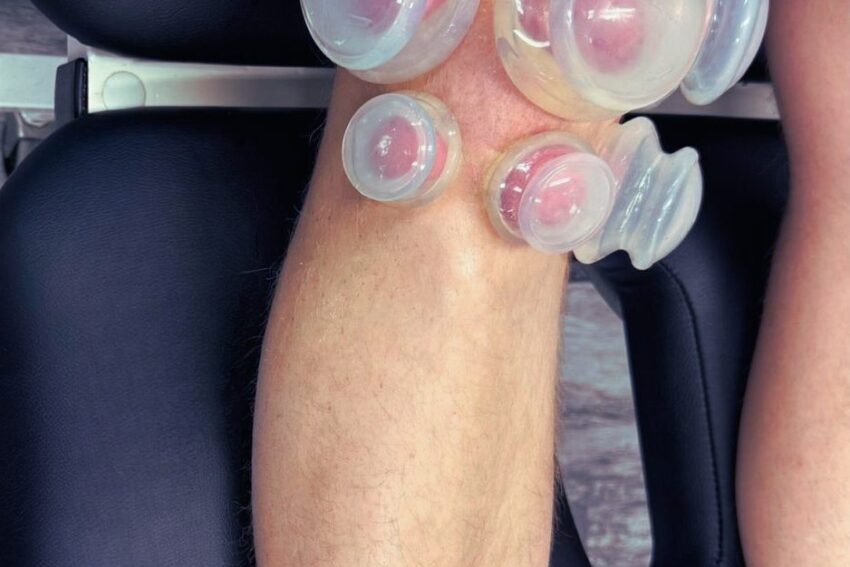 Cupping Therapy at TheraTouch Physio