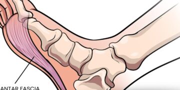 Plantar Fasciitis: Understanding Heel Pain