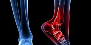 Ankle and Foot Injuries: Causes and Treatments.