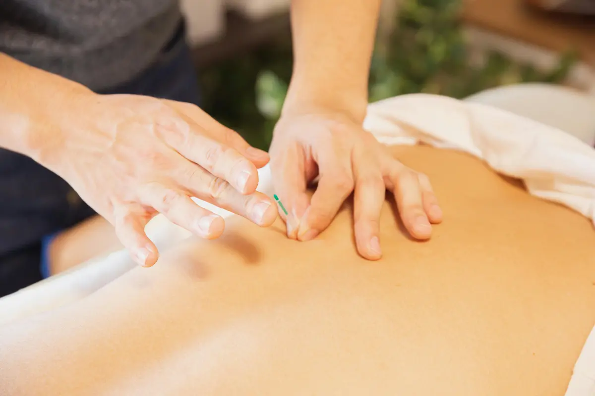 dry needling physiotherapy treatment for muscle trigger points and pain relief